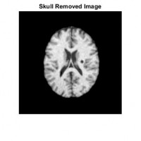 تشخیص سکته مغزی از روی تصاویر ct-scan مغز با روش SVM همراه دیتابیس