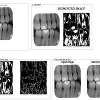 تشخیص عیوب دندان در رادیولوژِی و xray با پردازش تصویر همراه دیتابیس