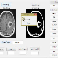 تشخیص نوع تومور های مغزی به خوش خیم و بدخیم با پردازش تصویر