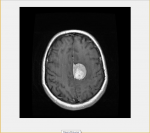 تشخیص تومور مغزی با تکنیک پردازش تصویر در متلب همراه گزارش و مقاله-1