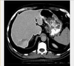 مشخص کردن ناحیه شش liver در تصویر CTSCAN بدن:انجام پروژه متلب-1