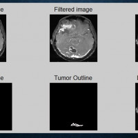 تشخیص تومور در تصاویر mri مغزی با تکنیک فیلتر انتشار ناهمسانگرد  