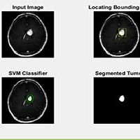 تشخیص دقیق ناحیه تومور مغزی با استفاده از دسته بندی به روش svm