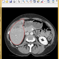 تشخیص ناحیه کبد در تصاویر بطنی شکم body xray در متلب