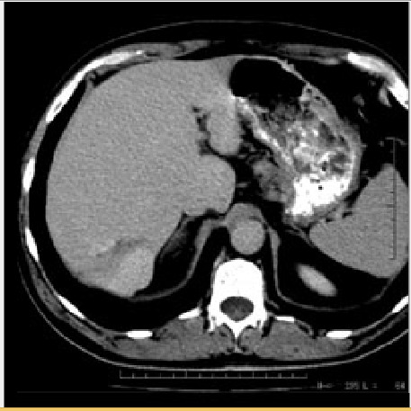 مشخص کردن ناحیه شش liver در تصویر CTSCAN بدن:انجام پروژه متلب