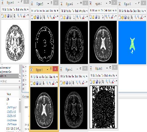 پروژه تشخیص سرطان مغز با الگوریتم واترشد با متلب