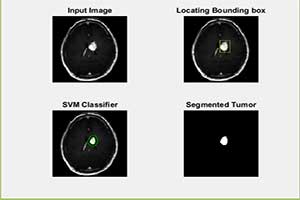 تشخیص دقیق ناحیه تومور مغزی با استفاده از دسته بندی به روش svm