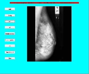 تشخیص سرطان پستان با تکنیک های پردازش تصویر