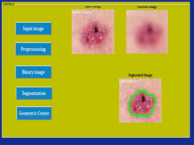 تشخیص سرطان پوست همراه با دیتاست و رابط گرافیکی در متلب