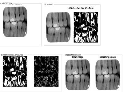 تشخیص عیوب دندان در رادیولوژِی و xray با پردازش تصویر همراه دیتابیس