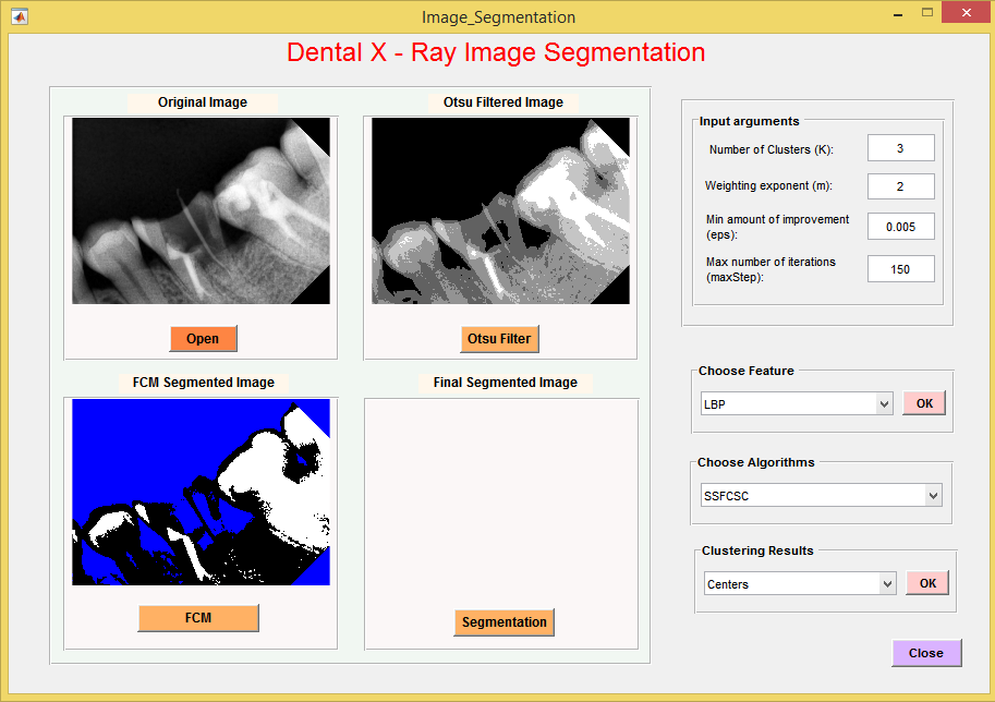 تشخیص و جداسازی دندان در تصاویر xray  در متلب با کمک روش FCM