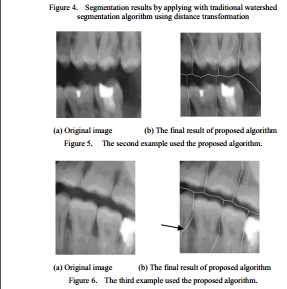 جداسازی تصویر مورفولوژی دندان با کمک الگوریتم واترشد در متلب